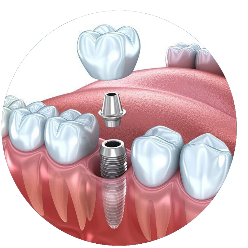 Implantologie și Chirurgie Dento-Alveolară