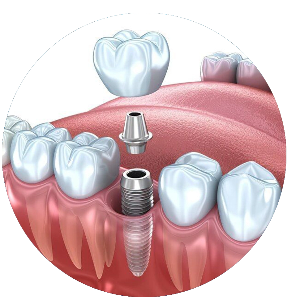 Implantologie și Chirurgie Dento-Alveolară